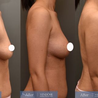 療程效果因人而異，上圖為D罩杯卻乳房下垂的女性在做完自體脂肪隆乳之後​手術後一個月、手術後八個月成效